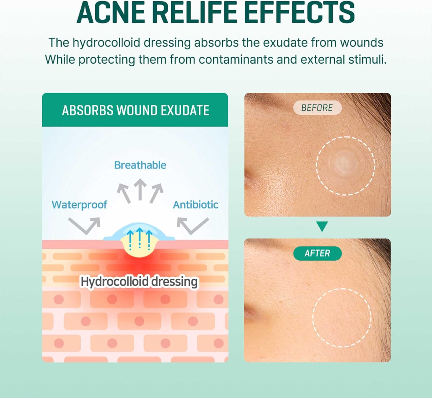 SOME BY MI 30 Days Miracle Clear Spot Patch (18 Patches)
