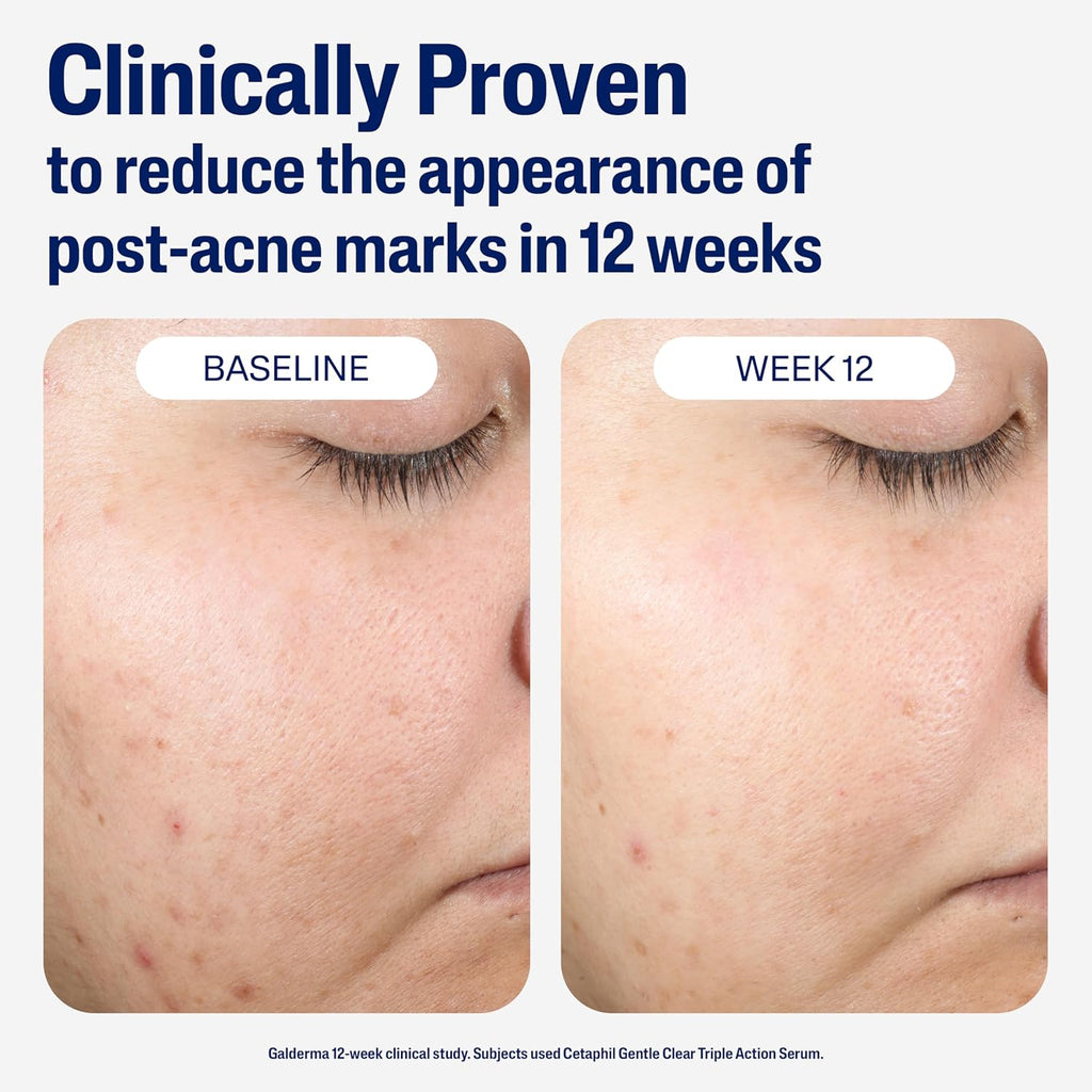 Cetaphil Gentle Clear Repairing Post-Acne Serum (30ml)