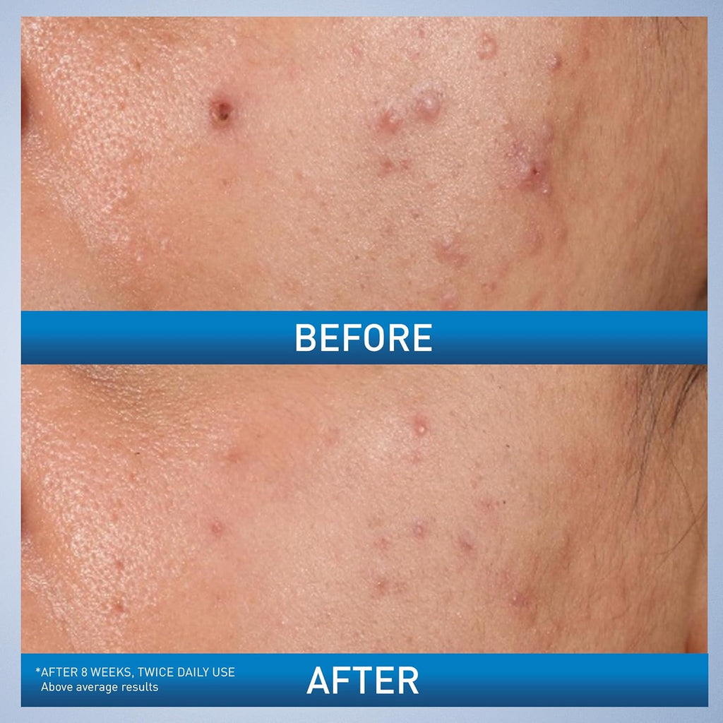 CeraVe Acne Control Gel - Acne Treatment (2% Salicylic Acid + AHA/BHA) 40ml