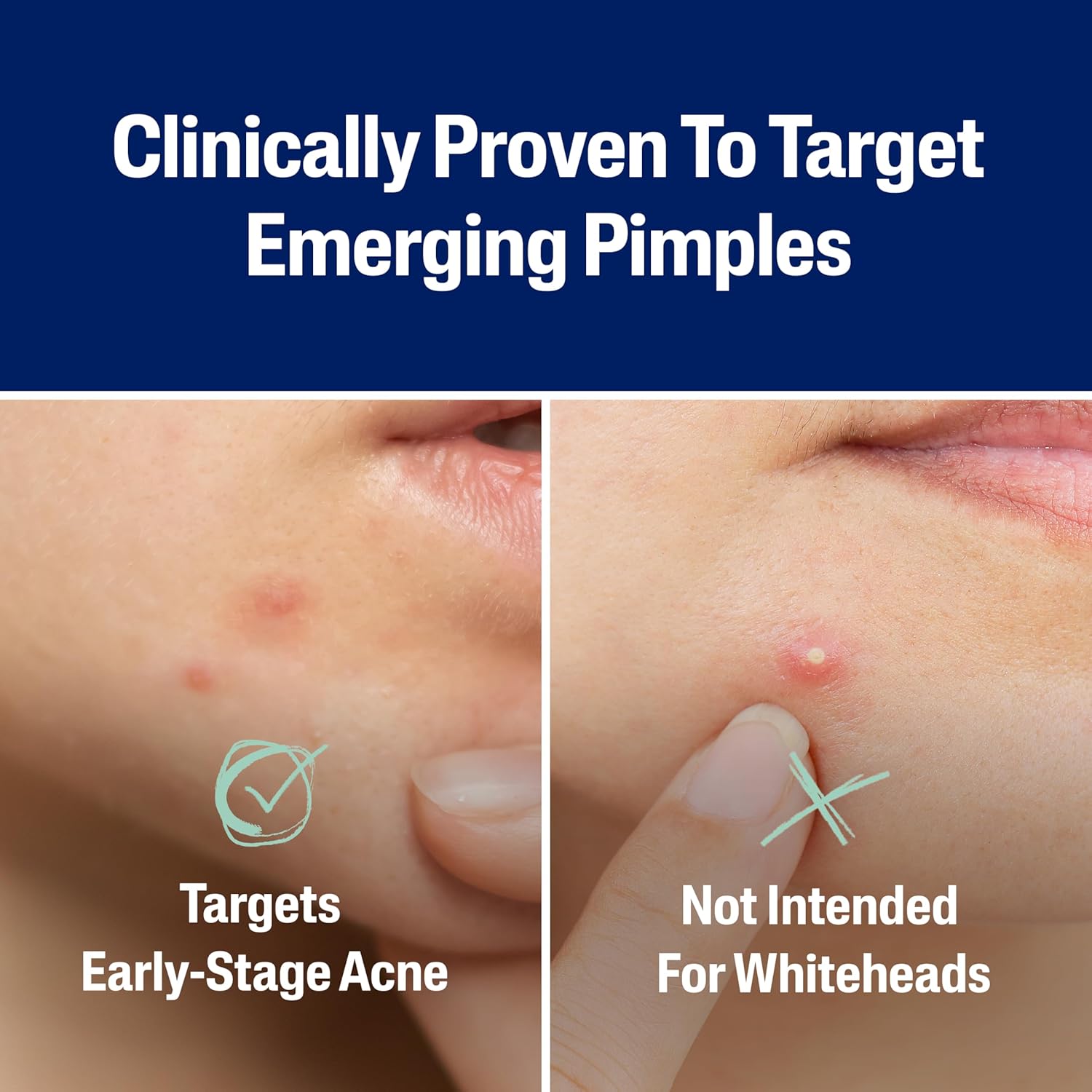 Cetaphil Acne Fast Rescue Pimple Patch - 24 Patches (2 sizes)