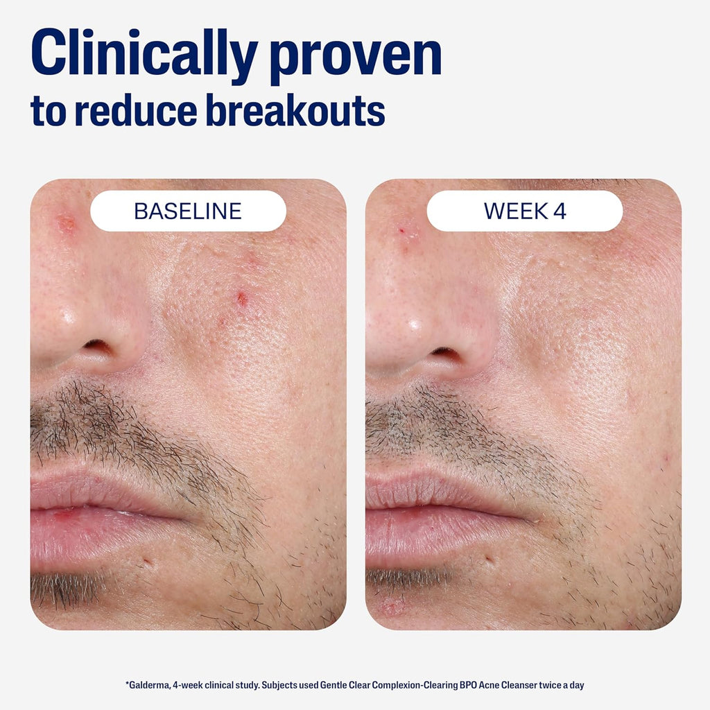 Cetaphil Gentle Clear Complexion Clarifying BPO Acne Cream Cleanser – 124ml